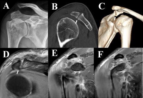 Preoperative examination of the right shoulder. A Right shoulder AP... | Download Scientific Diagram