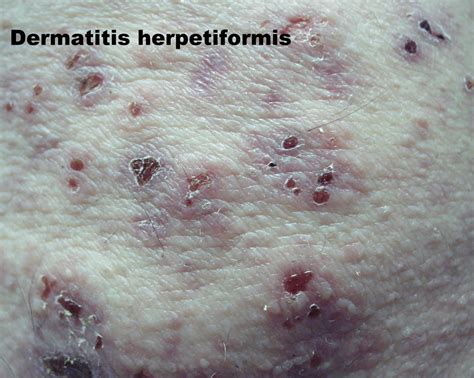 Dermatitis herpetiformis causes, symptoms, diagnosis and treatment