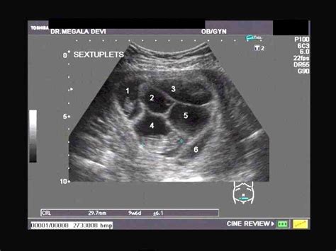 A Gallery of High-Resolution, Ultrasound, Color Doppler & 3D Images - Multifetal pregnancy