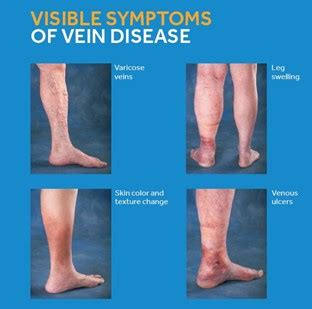 Venous Disease / Vein Clinic | Arizona Heart & Vascular Clinic