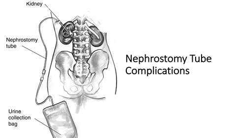 emDOCs.net – Emergency Medicine EducationComplications of Nephrostomy Tubes: ED Presentations ...