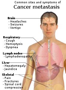 Cancer Symptoms: End Of Life Symptoms Cancer Patients