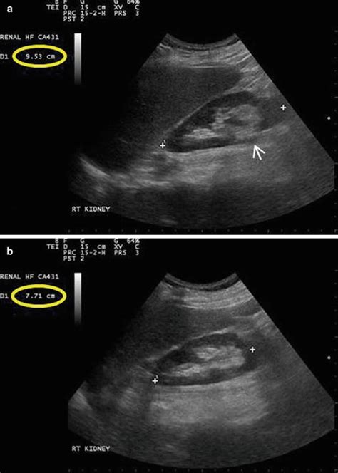 Renal Ultrasound Transverse