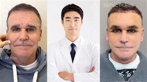 TikTok’s Elusive ‘Dr Kim’ Shares Post-Op Pics of $50,000 Facelift - Surgical Times