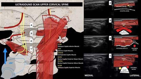 Ultrasound Scan of the Occipital and Upper Cervical Region – Annals of Headache Medicine Journal