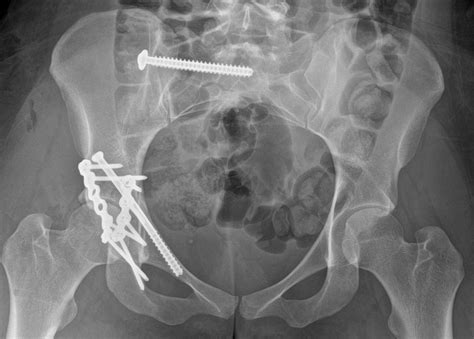 What is Ortho Trauma? — Orthopaedic Trauma Specialists