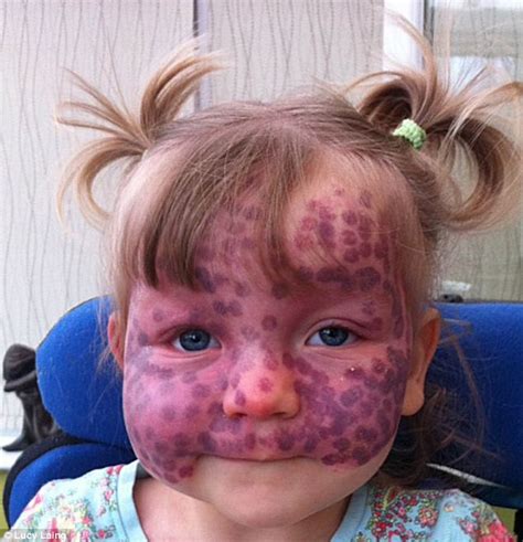 Toddler Matilda Callaghan, 2, treats severe birthmark with laser therapy | Daily Mail Online