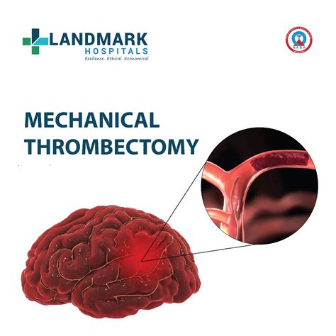 Neurology – Landmark Hospitals