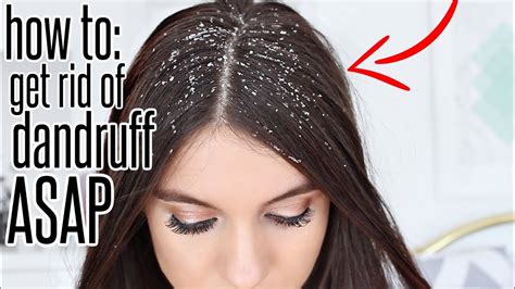 How To Lose Dandruff - Flatdisk24