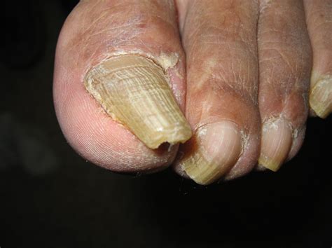 An Atlas of Nail Disorders, Part 6 | Consultant360