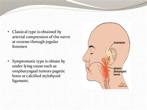 Glossopharyngeal nerve & its pathology ppt