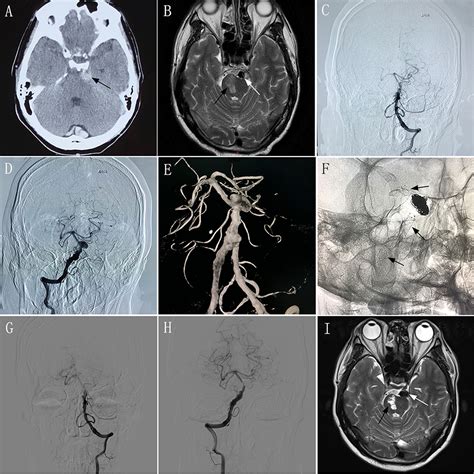 Basilar Artery Mri