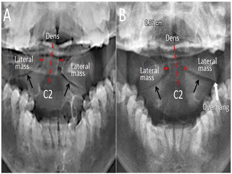 Atlantoaxial Rotatory Subluxation in a 10-Year-Old Boy - Eric Chun Pu Chu, Divya Midhun ...