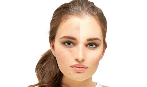 3 DIY Face Masks to Get Rid of Acne Scars at Home | India.com