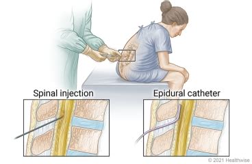 Spinal and Epidural Anesthesia | HealthLink BC