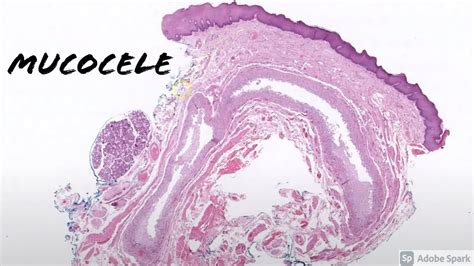 Mucocele Histology