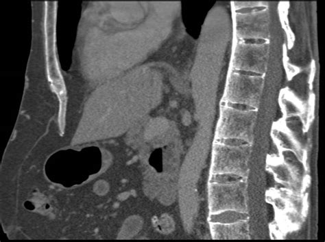 Ankylosing Spondylitis CT Scan