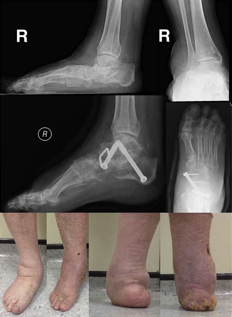 Death of the triple arthrodesis? - Orthopaedics and Trauma