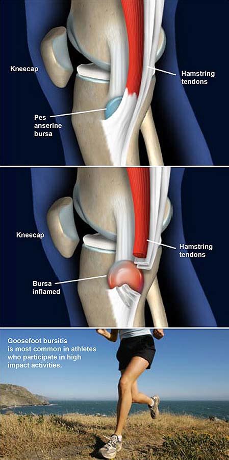 Goosefoot (Pes Anserine) Bursitis of the Knee | Central Coast Orthopedic Medical Group