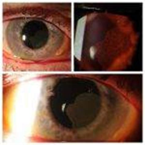 Cosmetic Eye Surgery Complications Pictures » Eyelid Surgery: Cost, Photos, Rewiews, Q&A