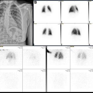 Example of a normal scan with both ventilation-perfusion and perfusion ...