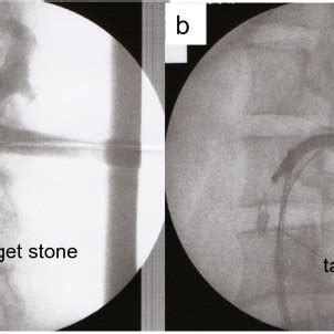 Percutaneous nephrolithotomy procedure in Case 1. | Download Scientific Diagram