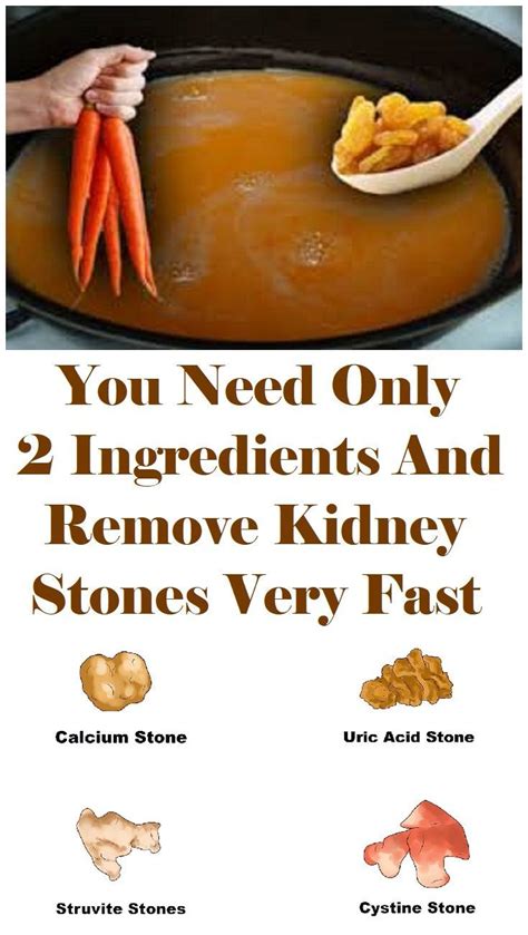 Can Exercise Help Pass Kidney Stones - HealthyKidneyClub.com