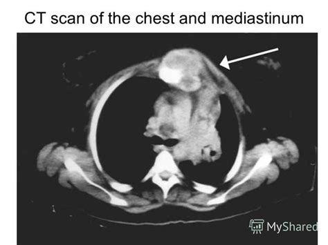 Презентация на тему: "MEDIASTINAL DISEASES Klymenko A.V. Скачать бесплатно и без регистрации.