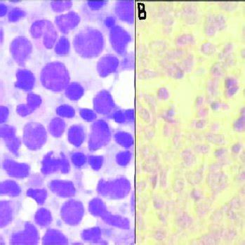 Cases showing positive correlation of bone marrow aspirate cytology and ...