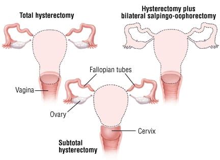 Patient Basics: Hysterectomy | 2 Minute Medicine