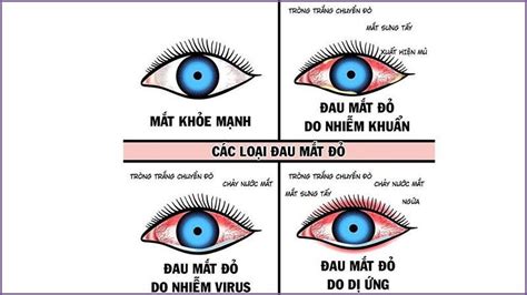 Đau mắt đỏ lây qua đường nào? Cách phòng ngừa bệnh đau mắt đỏ