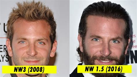 Bradley Cooper Hair Transplant Before After