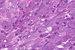 Acinic cell carcinoma - Libre Pathology