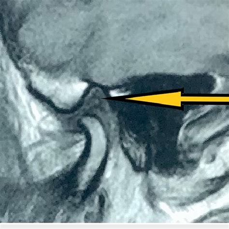 Excised left lateral pole of the condyle (Specimen) | Download ...