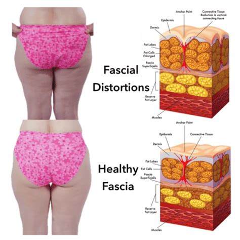 Fascia Blaster – What You Need to Know About Its Benefits – Your Shape ...