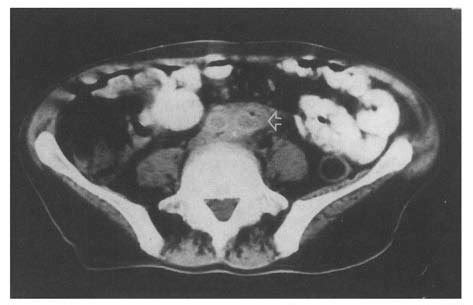 CT scan just below the level of bifurcation of the aortic graft. Arrow... | Download Scientific ...