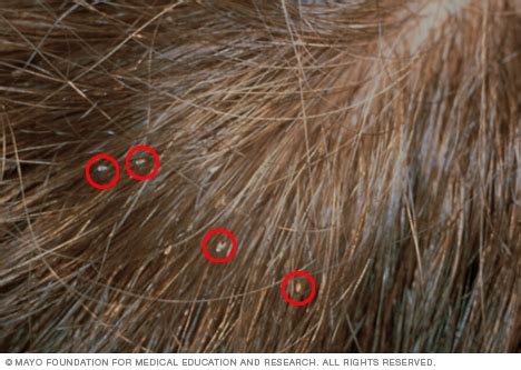 Lice - Symptoms and causes - Mayo Clinic
