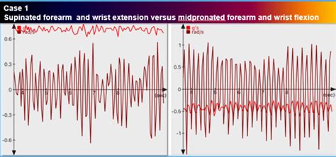 Positional variability in upper limb tremor in both essential and dystonic tremor: A case series ...