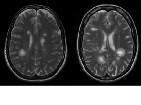 Esclerosis-Multiple-MSblog: Tumefactive Demyelinating Lesions / Lesiones Desmielinizantes Tumefactas