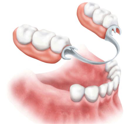 Partials - AdVance Dental PC | Dentist Birmingham AL