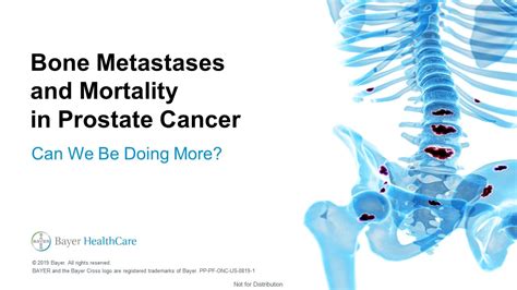 BONE METASTASES AND MORTALITY | Battle In The Bone