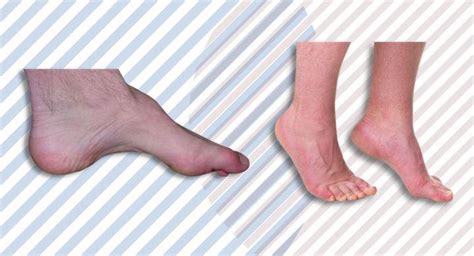 Equinus Deformity - Paragon Orthotic Laboratory