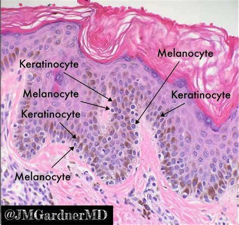 "Lentiginous nevus. Perfect example of melanocytes (grey, not pigmented ...