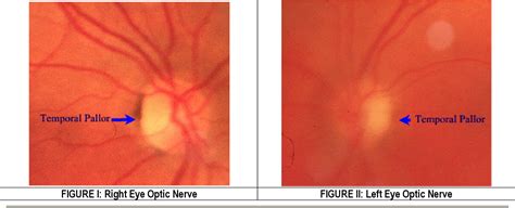 Figure I from Bilateral Internuclear Ophthalmoplegia as a Presenting ...