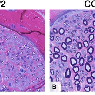 Sural nerve biopsy. Semi-thin resin sections from the patient's sural... | Download Scientific ...