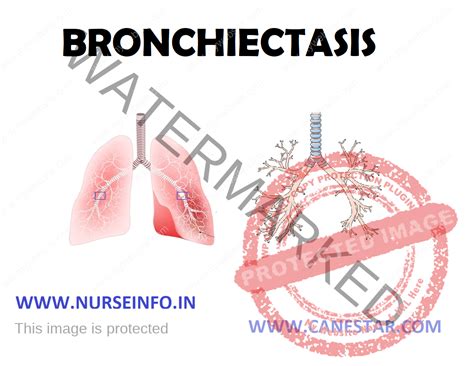 Bronchiectasis Signs And Symptoms