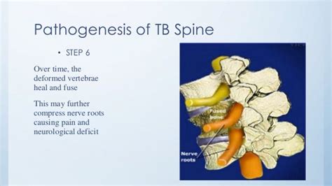 Tuberculosis of spine