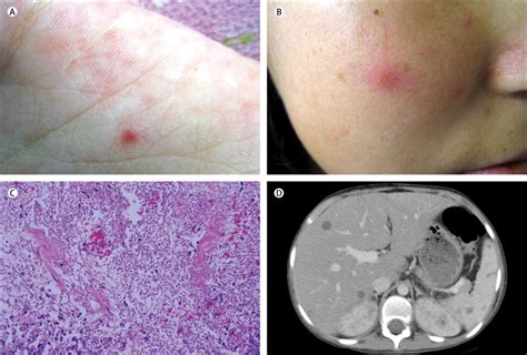 Cutaneous septic emboli from Candida tropicalis - The Lancet Infectious Diseases