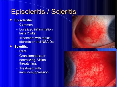 scleritis - DriverLayer Search Engine