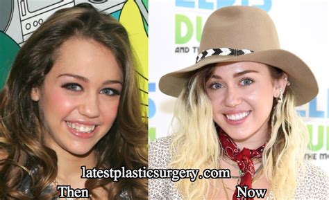 Miley cyrus fix her teeth - Latest Plastic Surgery Gossip And News ...